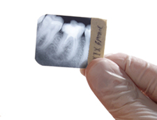 Dental Xray teeth  x-ray
